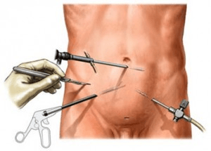 Orquiectomía laparoscópica