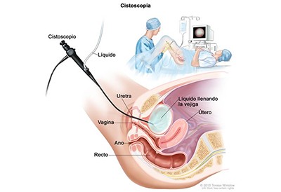 cistoscopia